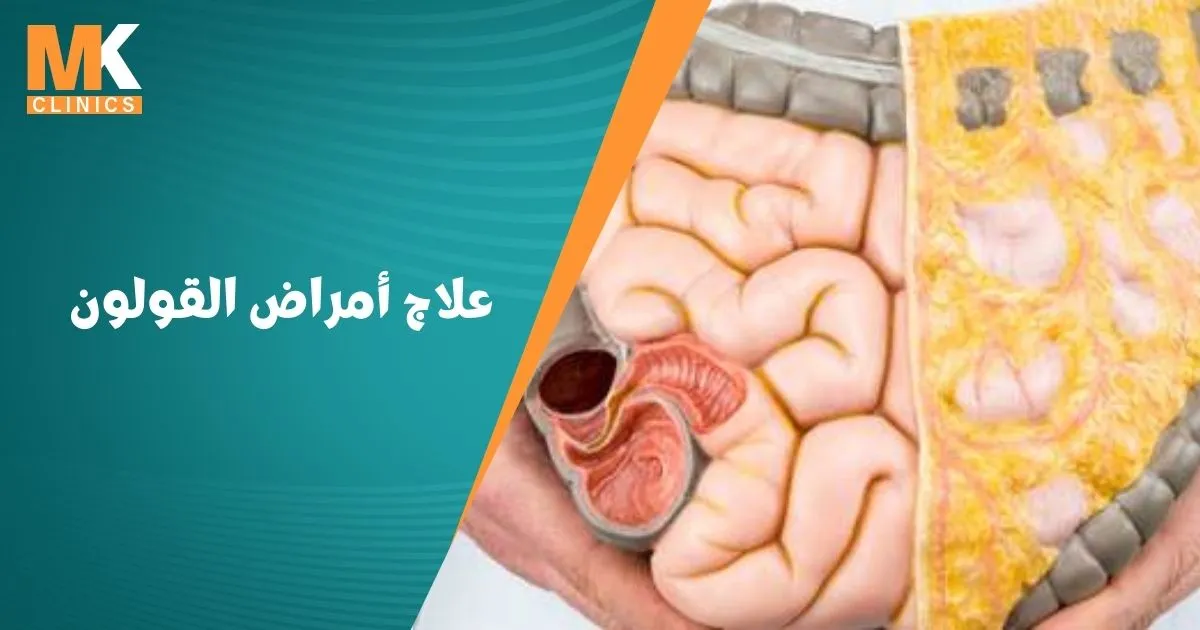 علاج أمراض القولون