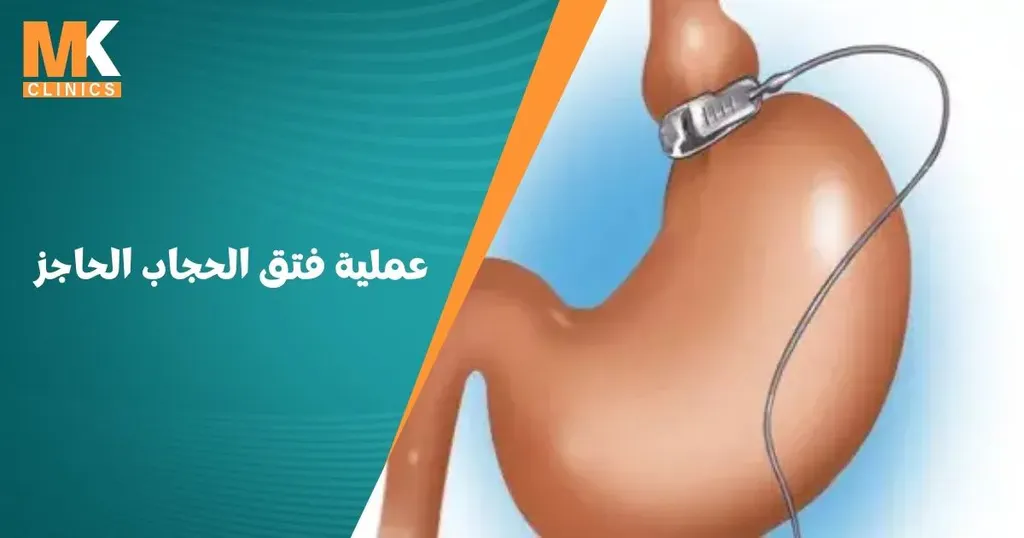 هل يلتئم فتق الحجاب الحاجز | دكتور محمد كريم عاشور 1 عملية فتق الحجاب الحاجز