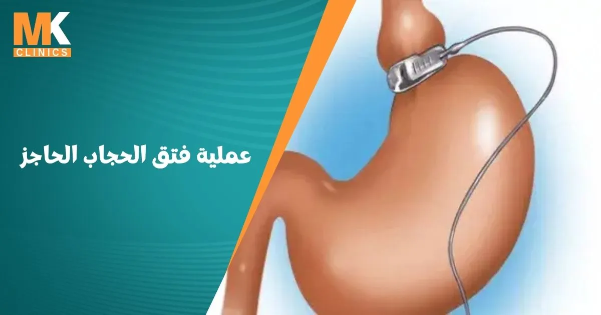 عملية فتق الحجاب الحاجز