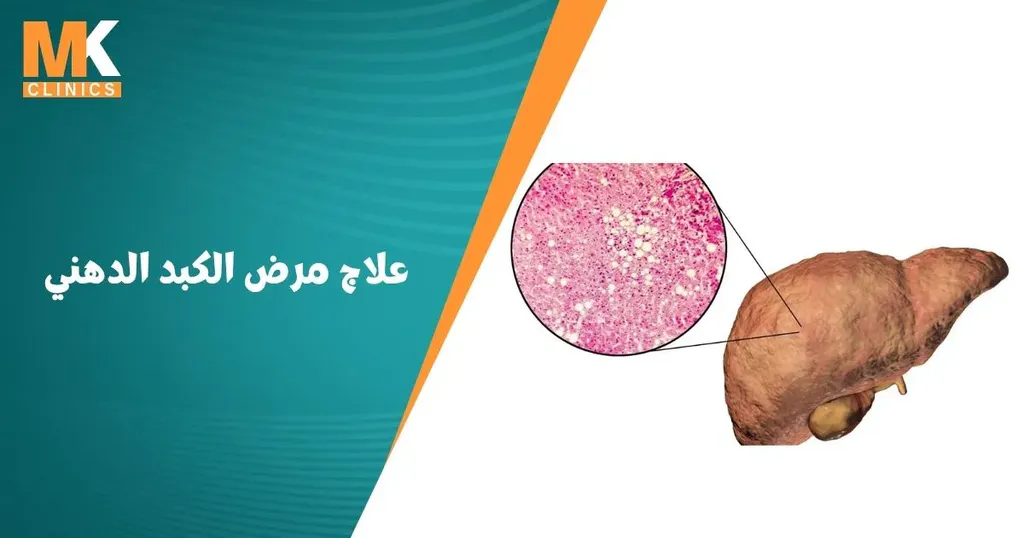 علاج مرض الكبد الدهني