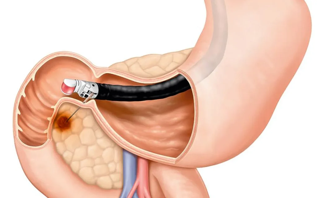 منظار الموجات الصوتية | ما هي تكلفة منظار eus ؟ 4 تكلفة منظار eus