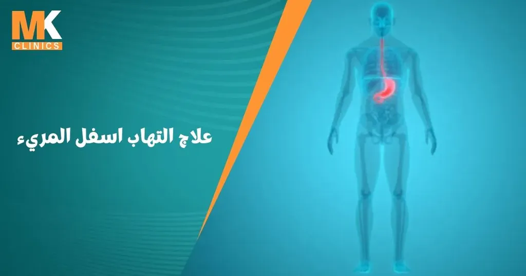 علاج التهاب اسفل المريء