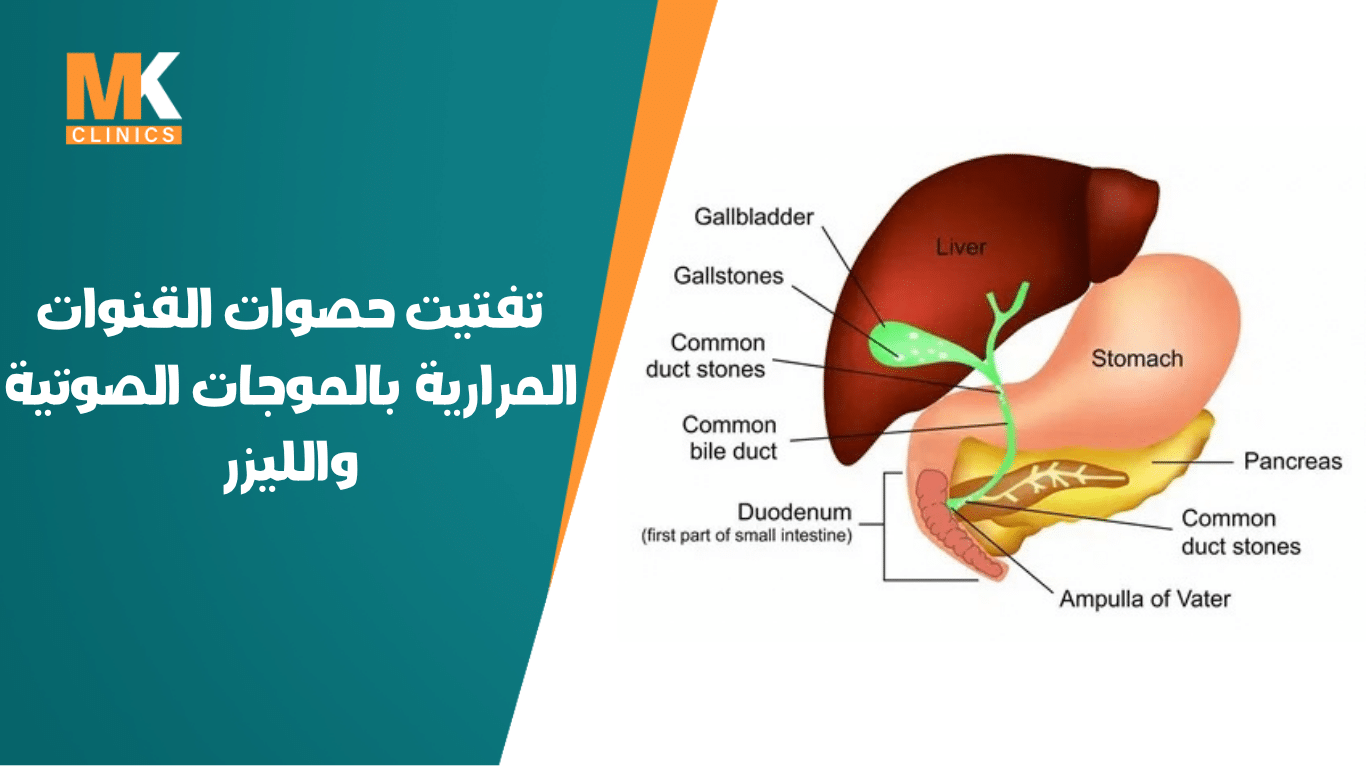 تفتيت حصوات القنوات المرارية