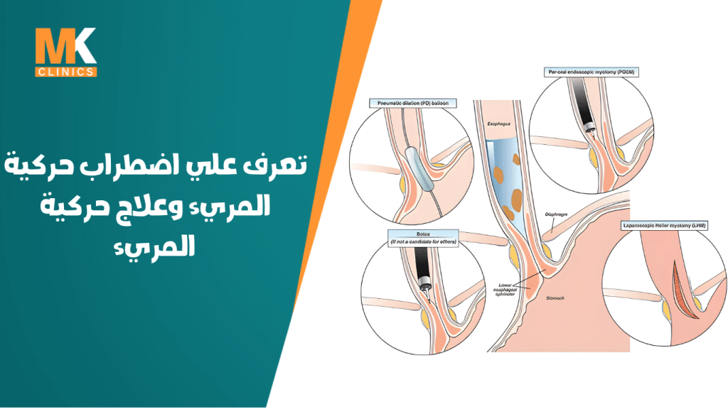 تعرف علي اضطراب حركية المريء وعلاج حركية المريء 10 حركية المريء