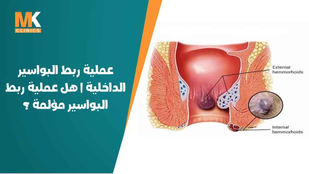 ربط البواسير