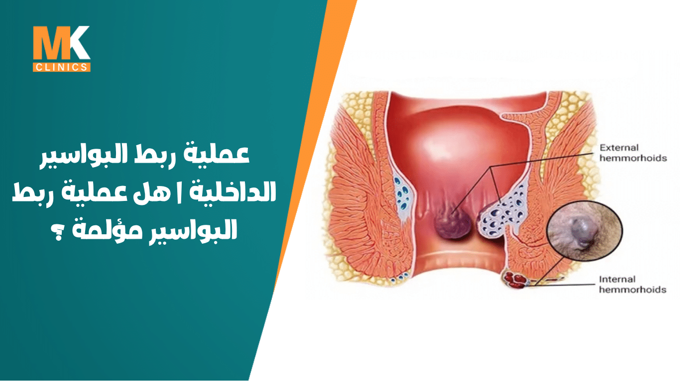 ربط البواسير