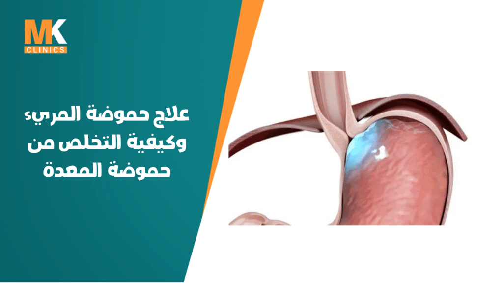 علاج حموضة المريء وكيفية التخلص من حموضة المعدة 3 علاج حموضة المريء