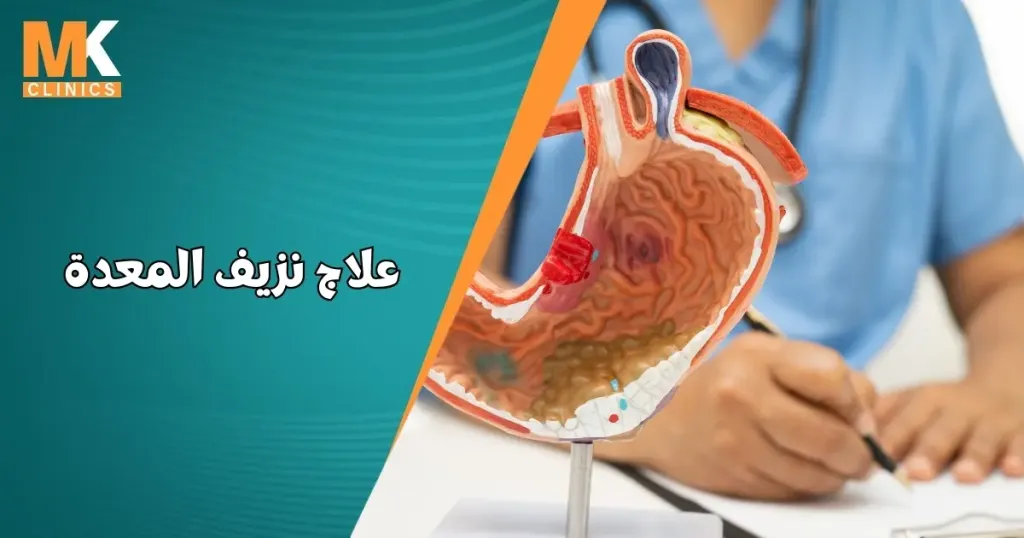 علاج نزيف المعدة