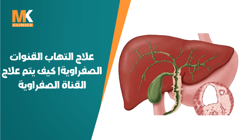 علاج التهاب القنوات الصفراوية| كيف يتم علاج القناة الصفراوية 19 علاج التهاب القنوات الصفراوية