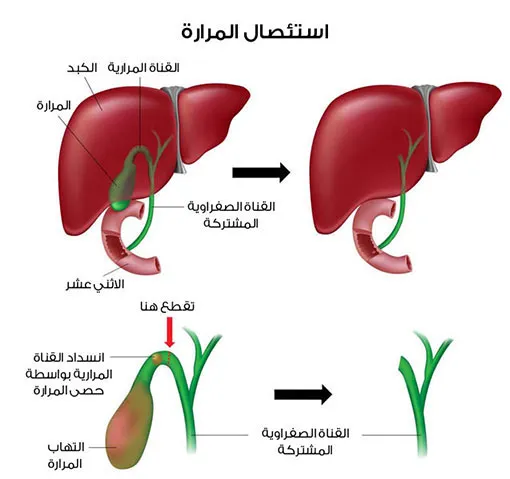 اعراض توسع القناة المرارية | هل توسع القناة المرارية خطير ؟ 1 توسع القناة المرارية بعد استئصال المرارة