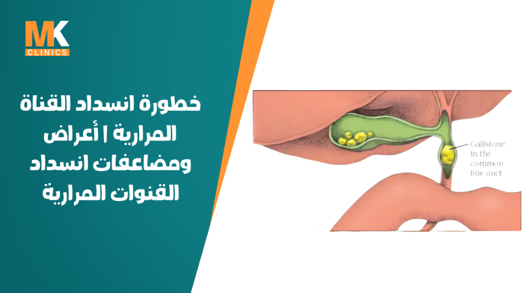خطورة انسداد القناة المرارية