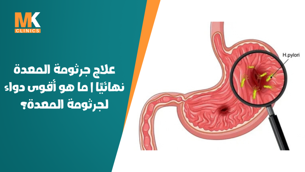 علاج جرثومة المعدة نهائيًا