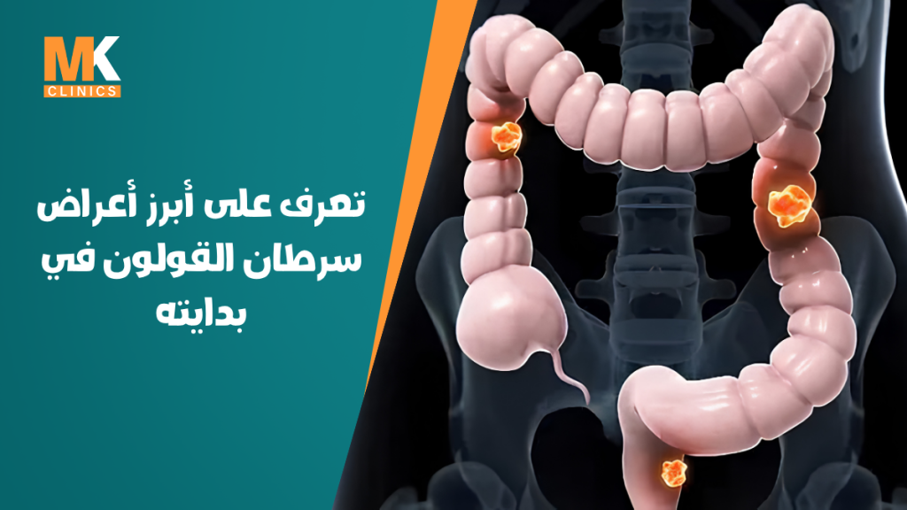 أعراض سرطان القولون في بدايته