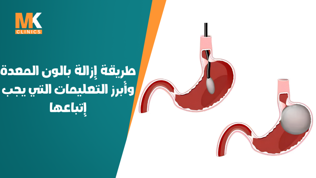 إزالة بالون المعدة