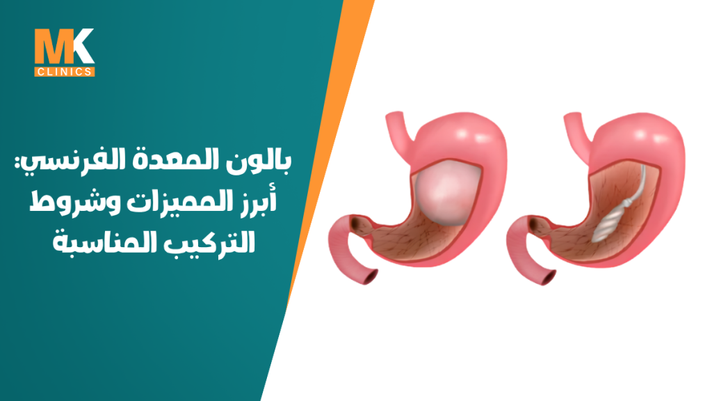 بالون المعدة الفرنسي