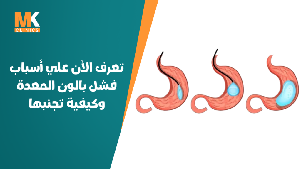 أسباب فشل بالون المعدة