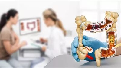 علاج أمراض القولون بالمنظار