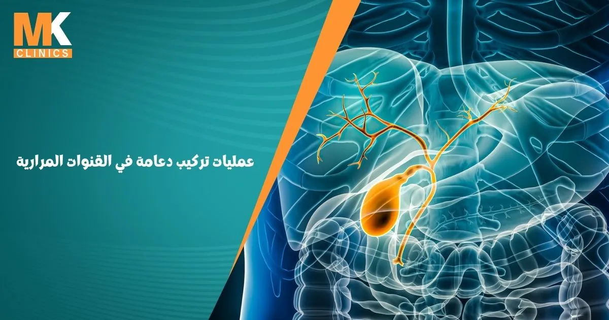 عمليات تركيب دعامة في القنوات المرارية