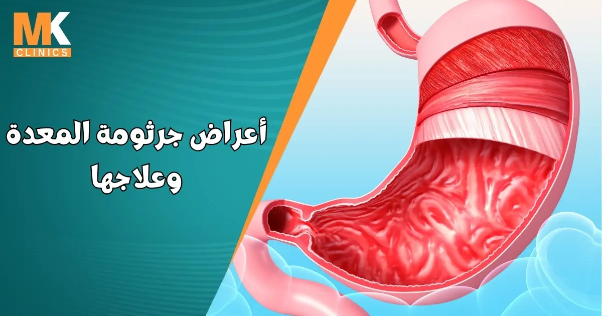 اعراض جرثومة المعدة وعلاجها