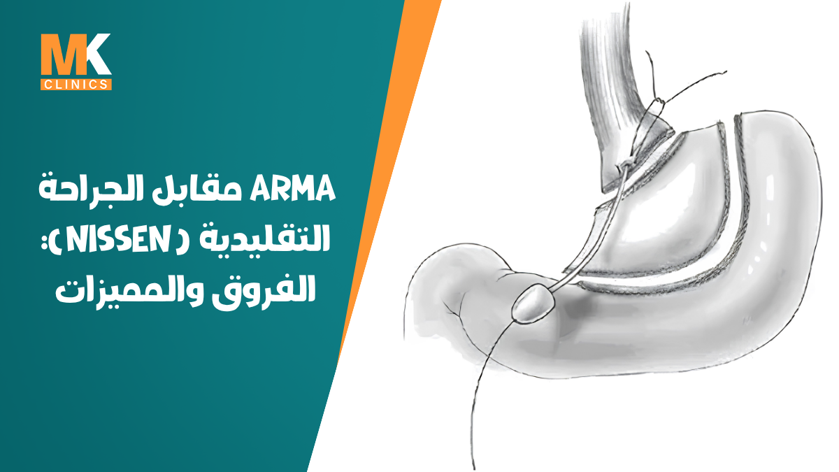 جراحة ارتجاع المريء
