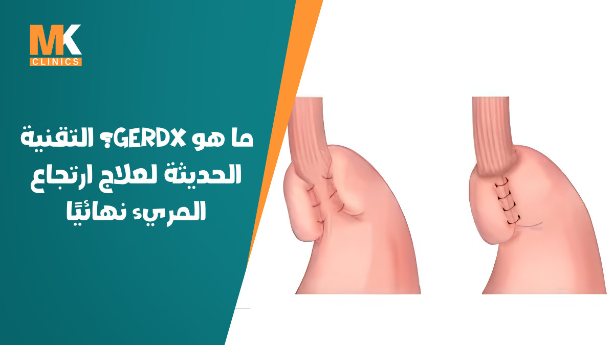 gerdx