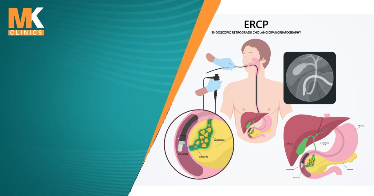 خطوات إجراء منظار ERCP