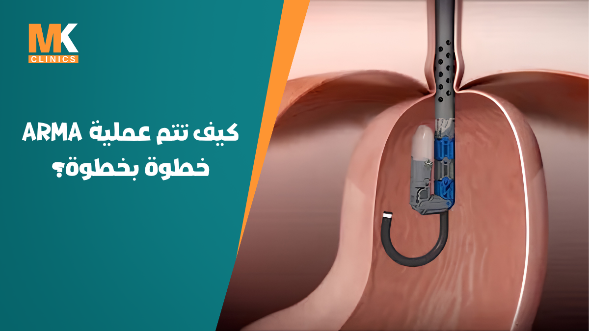 علاج ارتجاع المريء بالمنظار