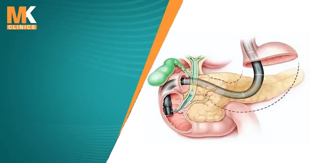 ما هو منظار ERCP وما هي استخداماته؟