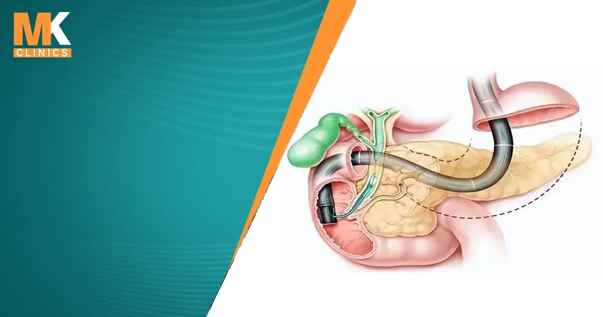 ما هو منظار ERCP وما هي استخداماته؟