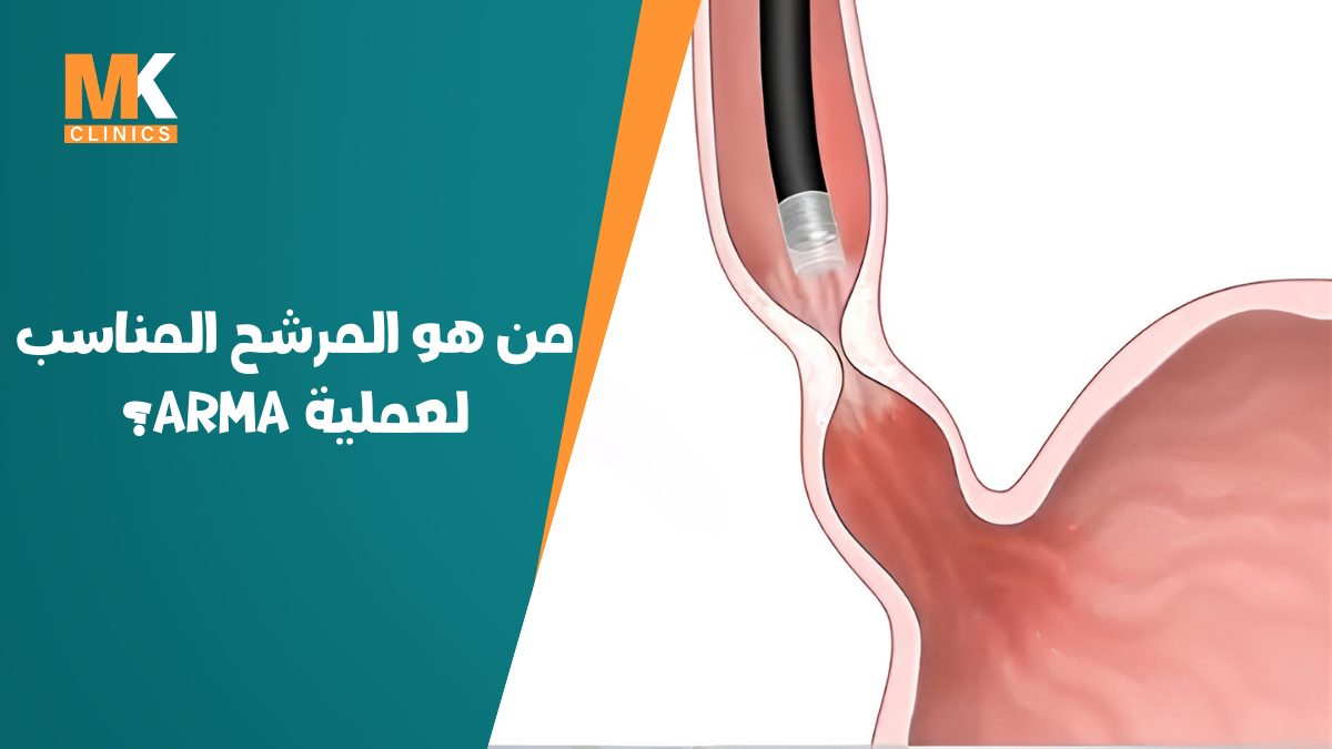 ارتجاع المريء الشديد