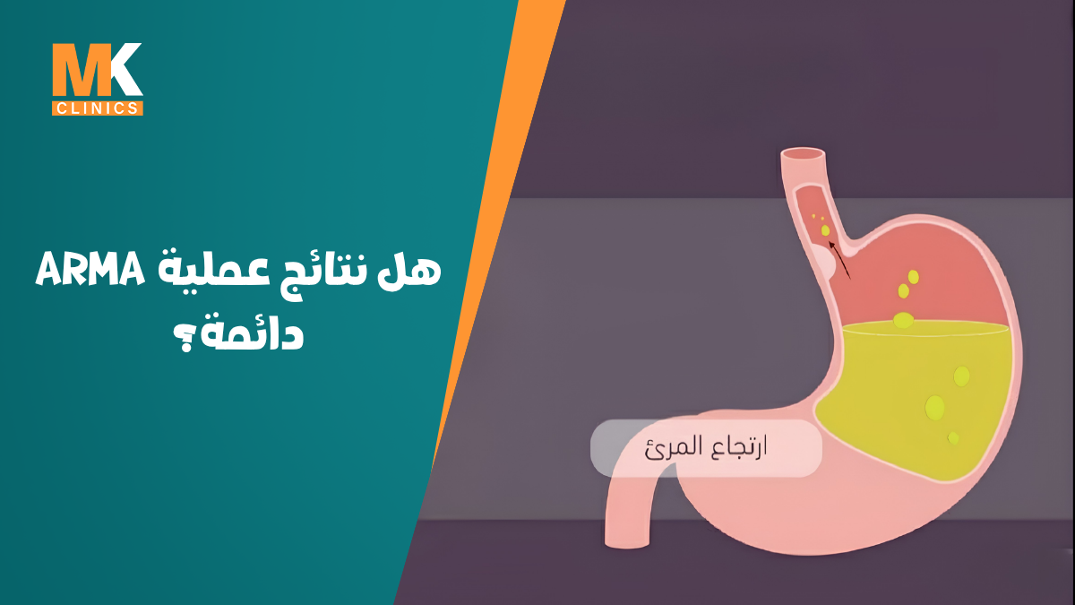 ارتجاع المريء