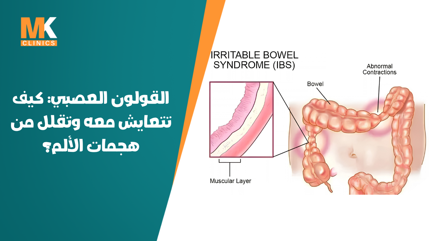 القولون العصبي