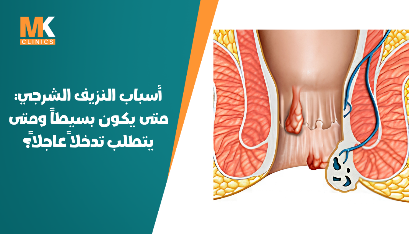 النزيف الشرجي