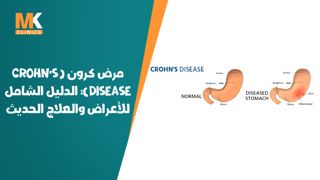 مرض كرون